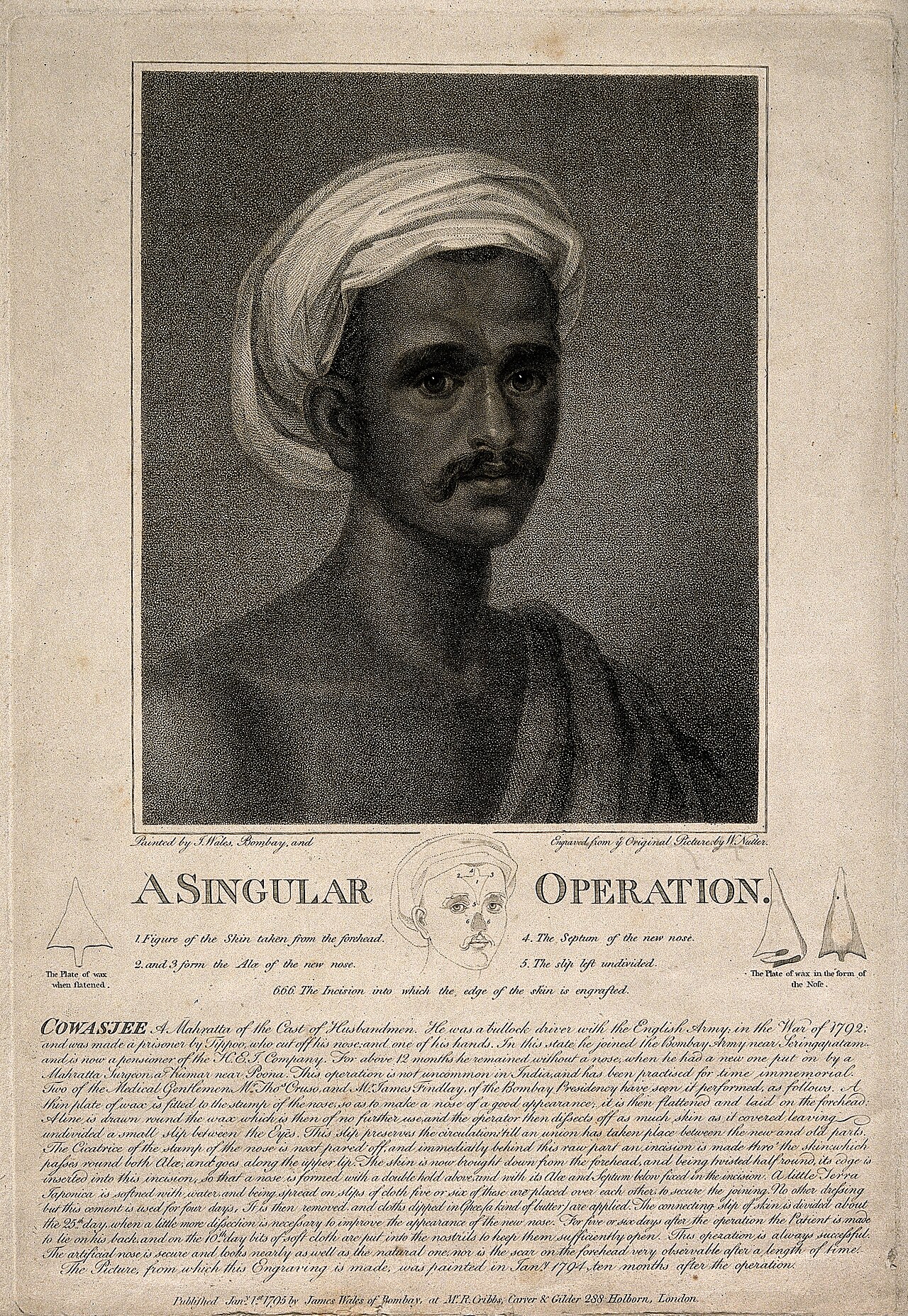 The 1794 illustration of Cowasjee, whose nose was rebuilt by the Indian method